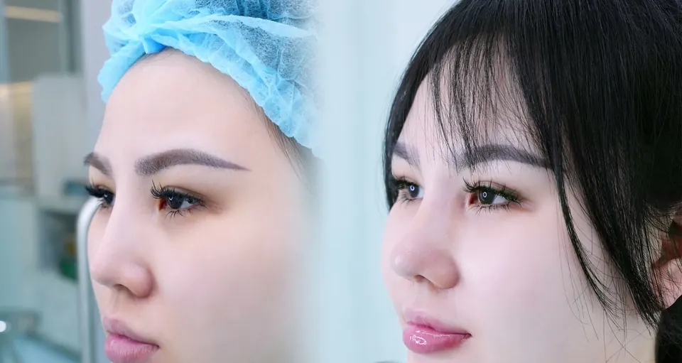 Trước và sau nâng mũi, góc 3/4