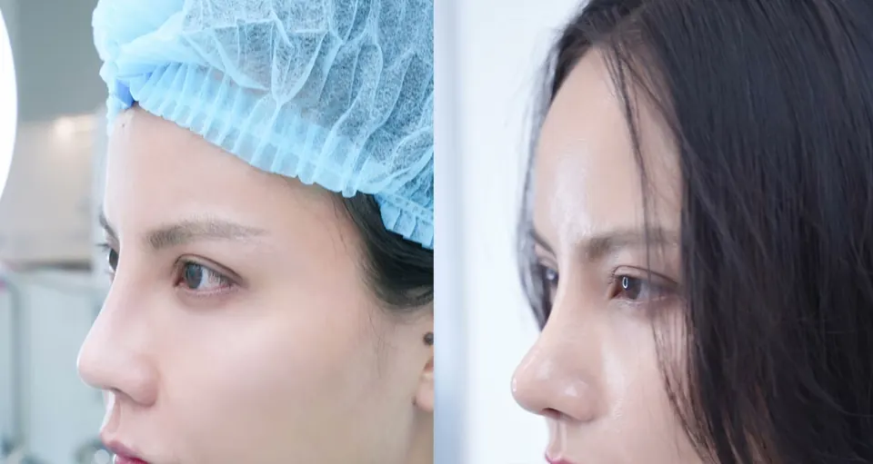 Trước và sau nâng mũi, góc nghiêng