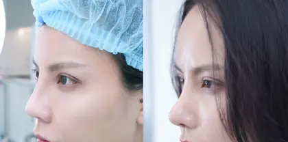 Trước và sau nâng mũi