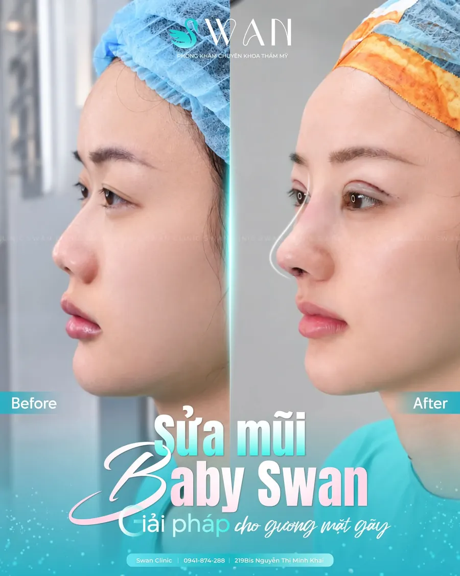 Sửa mũi Baby Swan trước và sau