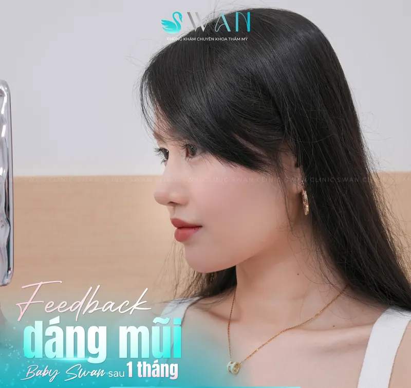 Dáng mũi Baby Swan sau 1 tháng, góc nghiêng