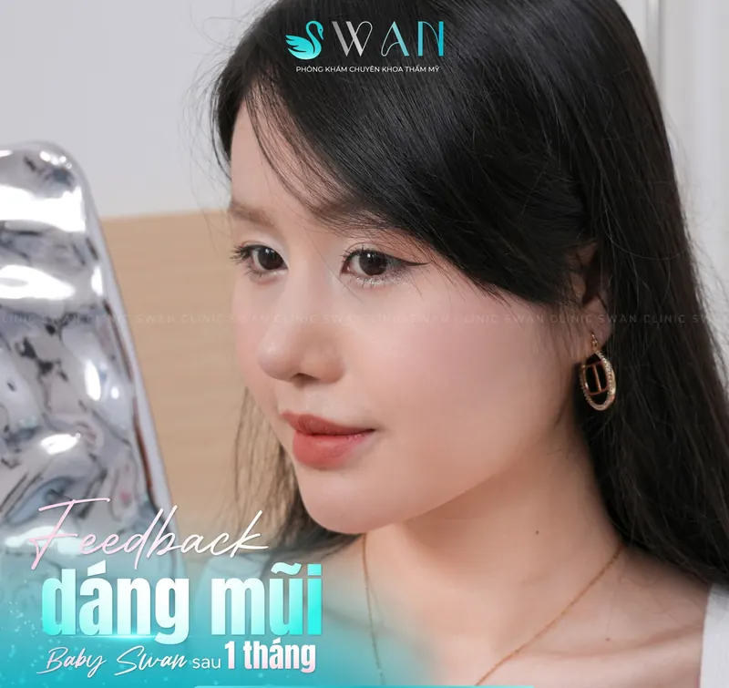 Dáng mũi Baby Swan sau 1 tháng, góc 3/4