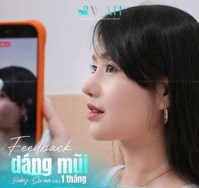 Dáng mũi Baby Swan sau 1 tháng