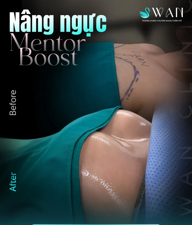Nâng ngực Mentor Boost góc nghiêng