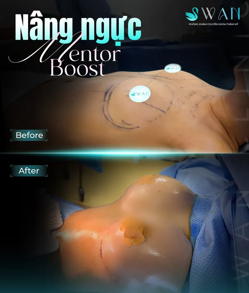 Nâng ngực Mentor Boost trước và sau